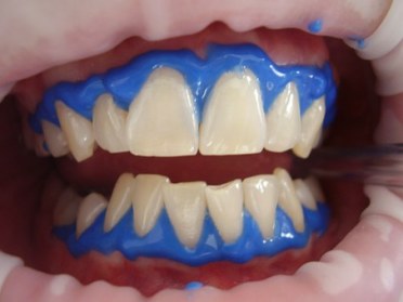 laser-teeth-whitening-716468__340