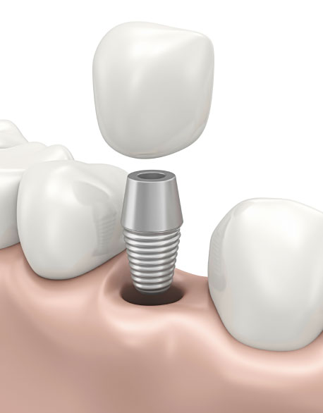 dental implant services in NY. 